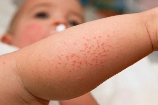 rashes due to parasites