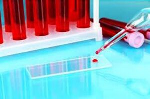 Emeoscania of the blood fell for parasites