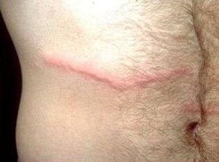How to get rid of subcutaneous parasites in humans