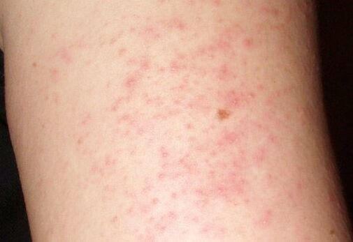 Itchy skin rashes are a symptom of the presence of worms in the liver