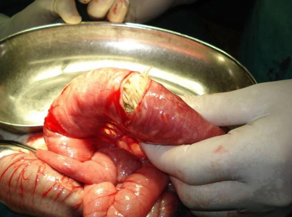Nematodes in the human intestine